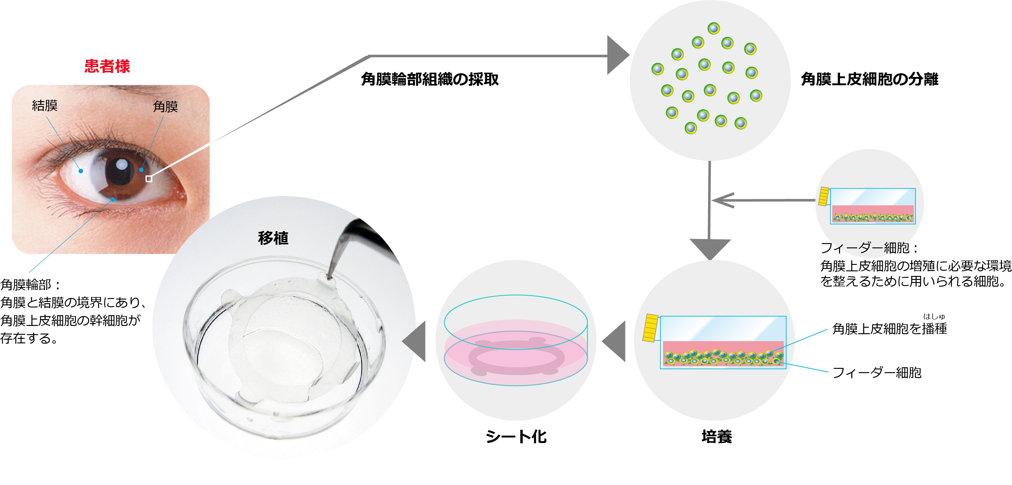 「EYE-01M」は、患者自身の角膜輪部組織から角膜上皮幹細胞を採取してシート状に培養したもので、本品を移植することにより角膜上皮を再建させることを目的としています。