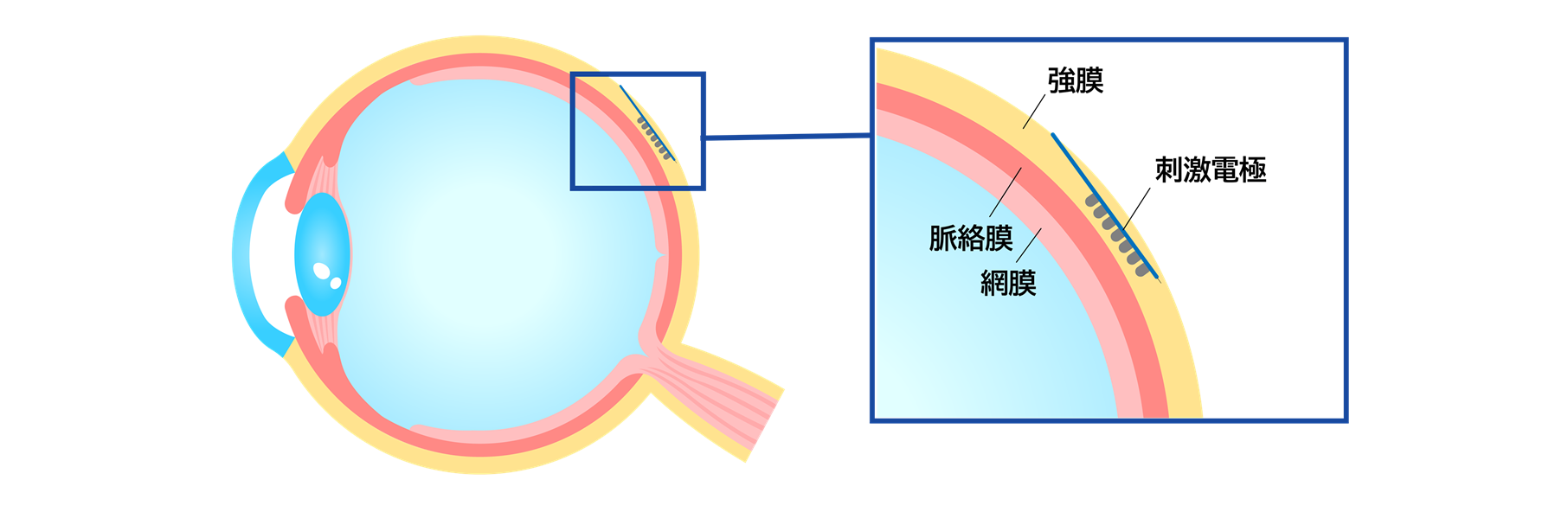 電極の埋植